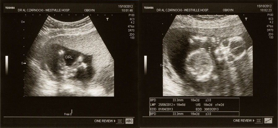 16 Week Scan