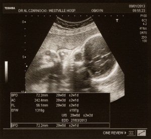 Baby Girl Prior At 28 Weeks