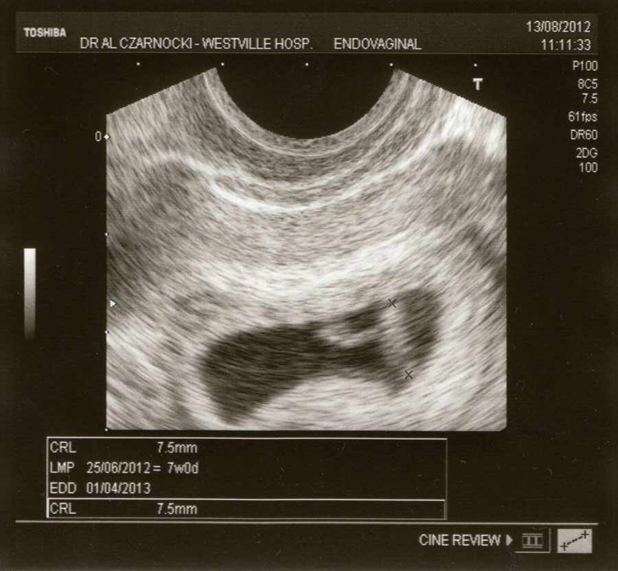 7 Week Scan