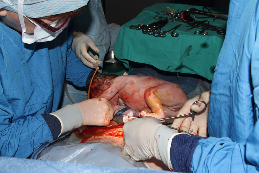 The Cesarean