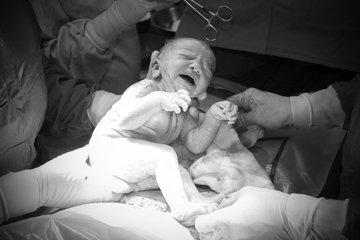 Katie's Cesarean Section