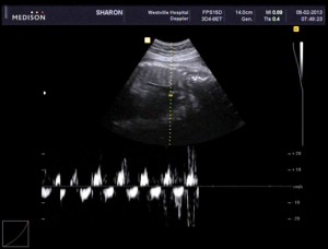 Our Little Girl's Heartbeat