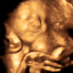 Baby Girl Prior In 4D - Smiling With Her Chubby Cheeks