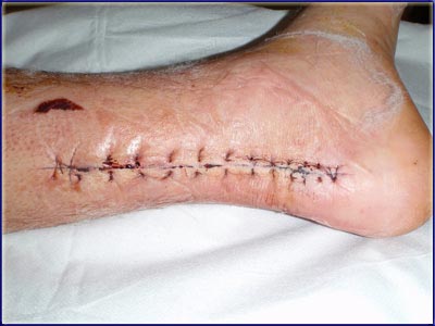My Sutures, Post Achilles Op