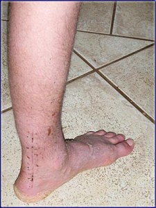 My Foot, After The Cast Came Off